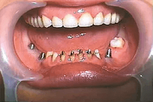 импалнтация зубов до-после