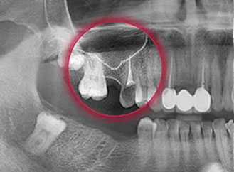 импланты зубов в твери цена под ключ