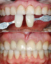 Реставрация зубов